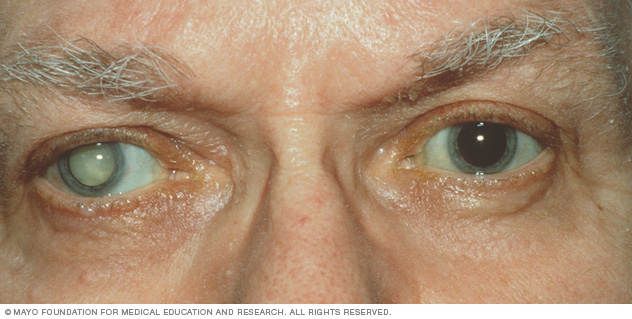 Image result for cataracts