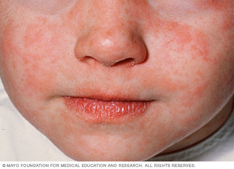 Photograph of measles rash