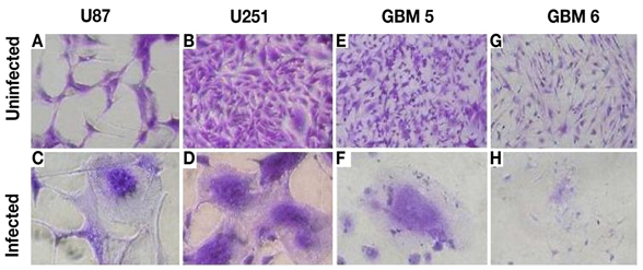 Images of glioma cells that have fused to form syncytia