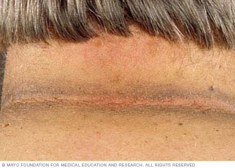 Photo of acanthosis nigricans 
