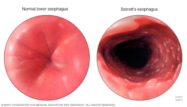 Endoscopy view of Barrett's esophagus