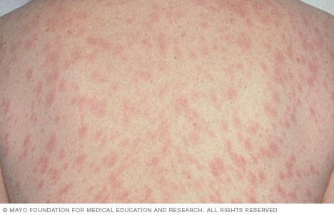 What is red rash around lower leg above the ankle? - MedHelp