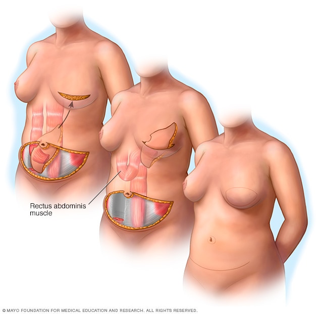 رسم توضيحي يظهر إجراء شريحة عضلة جدار البطن المستقيمة المستعرضة للسديلة العنيقية