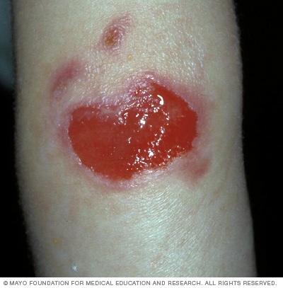 La epidermólisis bullosa juntural puede ser grave y causar llagas abiertas.