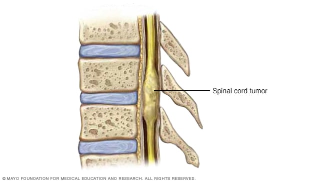 Ilustración de un tumor en el interior de la médula espinal