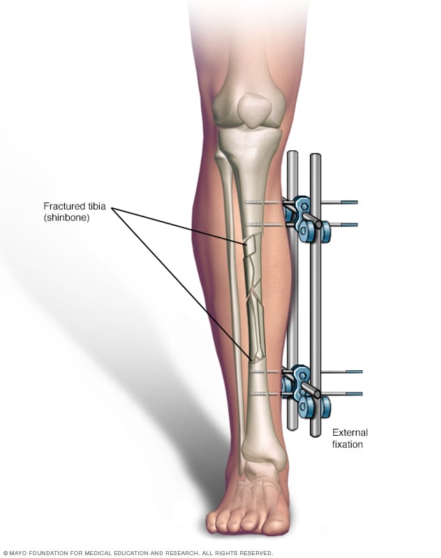Ilustración de una pierna fracturada con fijación externa 