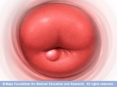 Medical illustration of a cervical cyst 
