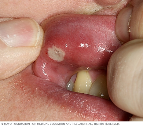 Photograph showing canker sore
