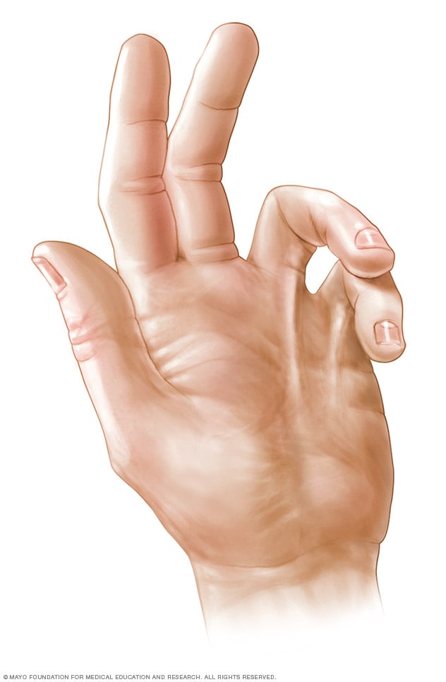 Dupuytrens Contracture Symptoms And Causes Mayo Clinic