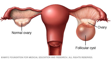 Quiste folicular en el ovario