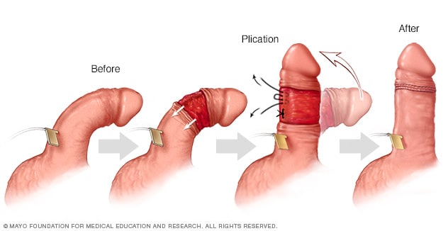 Plication procedure of the penis to correct curvature