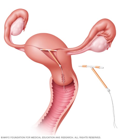 ParaGard IUD in place in the uterus