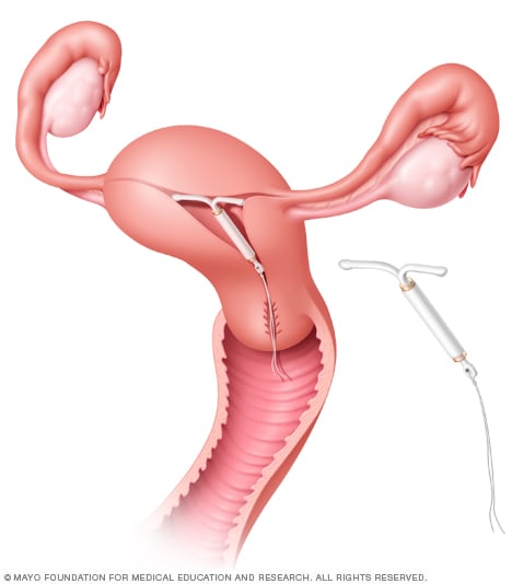 放置在子宫中的 Mirena 宫内节育器（IUD）