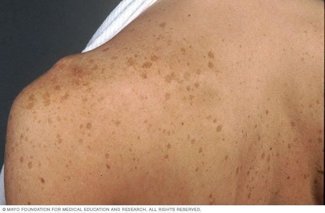 Age spots (liver spots) - Symptoms and causes - Mayo Clinic