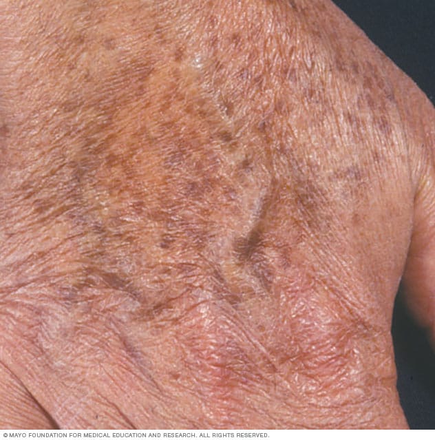 Age spots on the hand