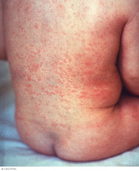 Photograph of rubella rash
