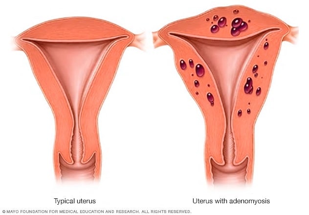 Typical uterus vs. uterus with adenomyosis