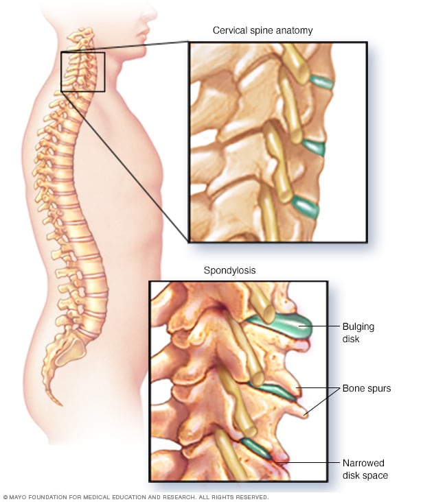 Cervical spondylosis