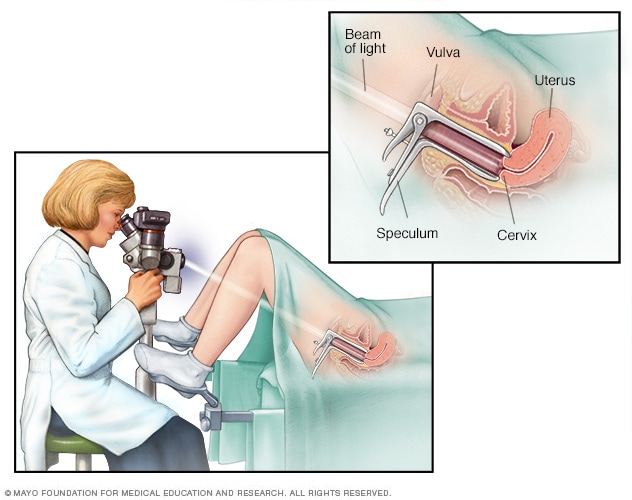 Colposcopy 