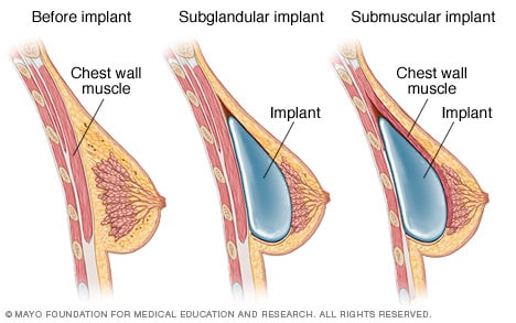 Colocación de implantes mamarios