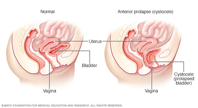 Normal bladder position compared with prolapsed bladder (cystocele)