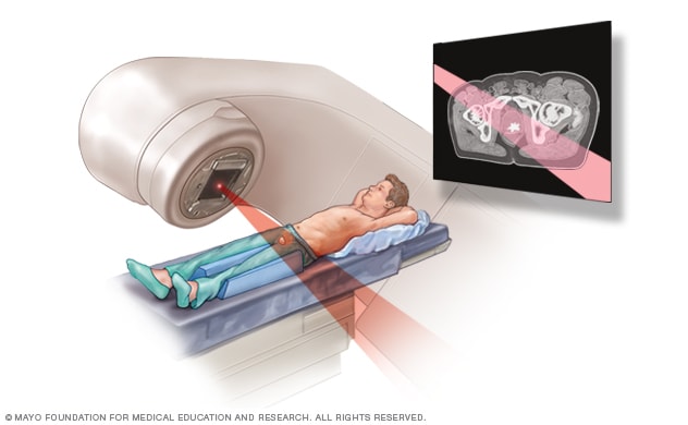 External beam radiation for prostate cancer