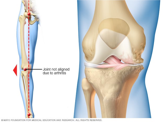 Cómo la artrosis puede afectar solo un lado de la rodilla.