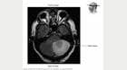 MRI showing a brain lesion