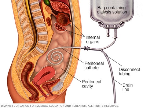 显示如何进行腹膜透析的图像