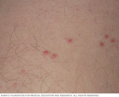 Bedbug bites are often located on the face, neck, arms and hands