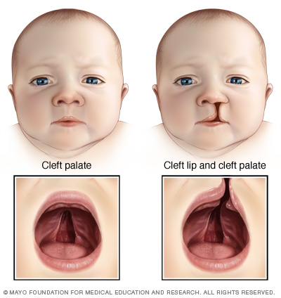 Corticosteroid use during pregnancy and risk of orofacial clefts