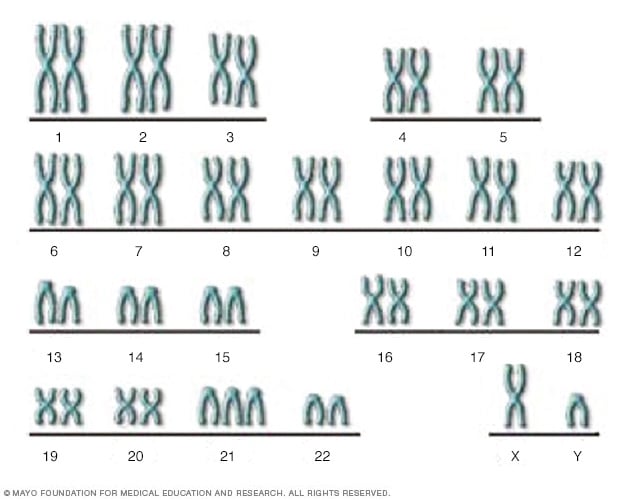 Ilustración de los cromosomas de una persona con síndrome de Down