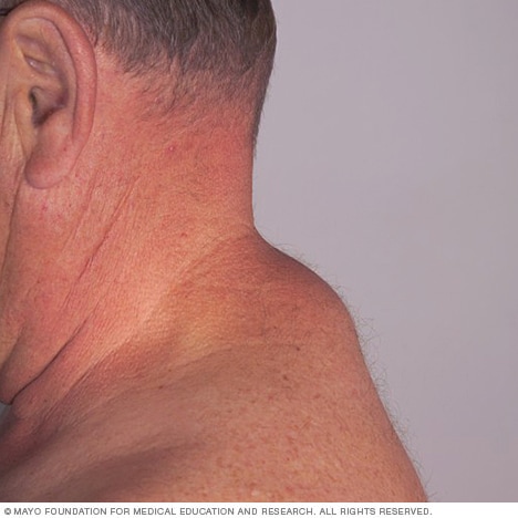 Lipoma - Mayo Clinic
