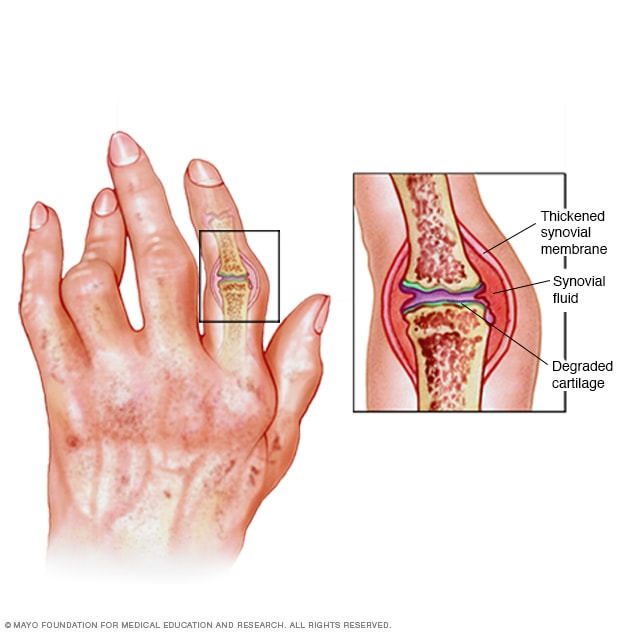 Inflamación de artritis reumatoide