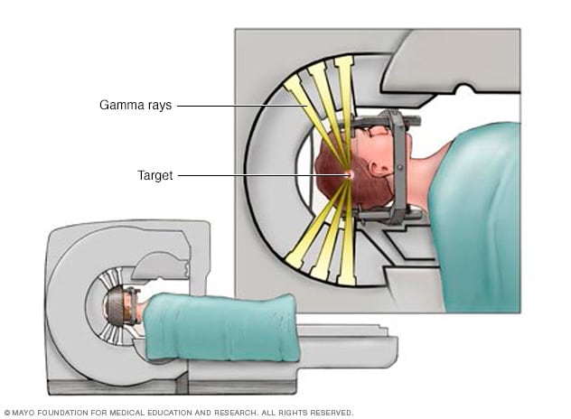What is Gamma knife surgery?