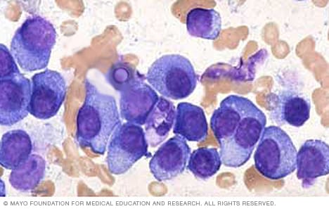 Imagen de células de mieloma 
