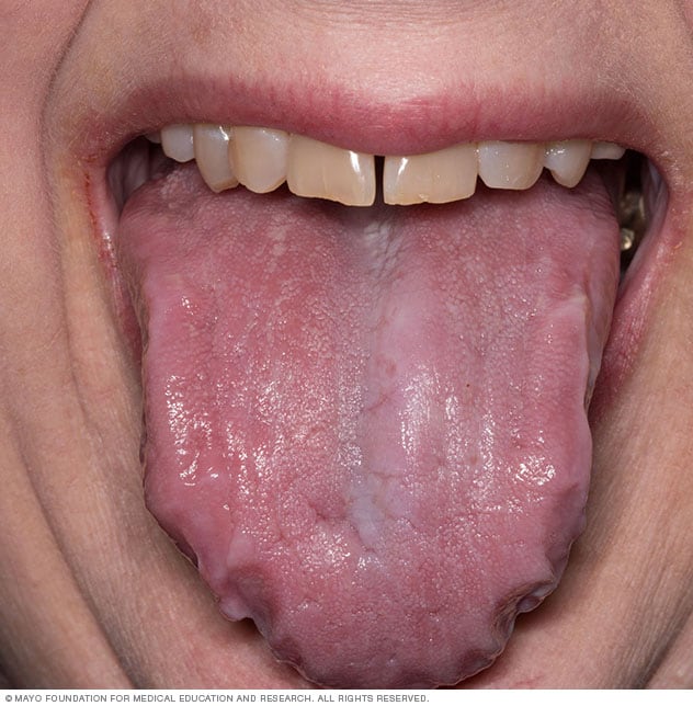 Enlarged tongue, a sign of amyloidosis