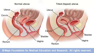 Illustration showing a tilted uterus
