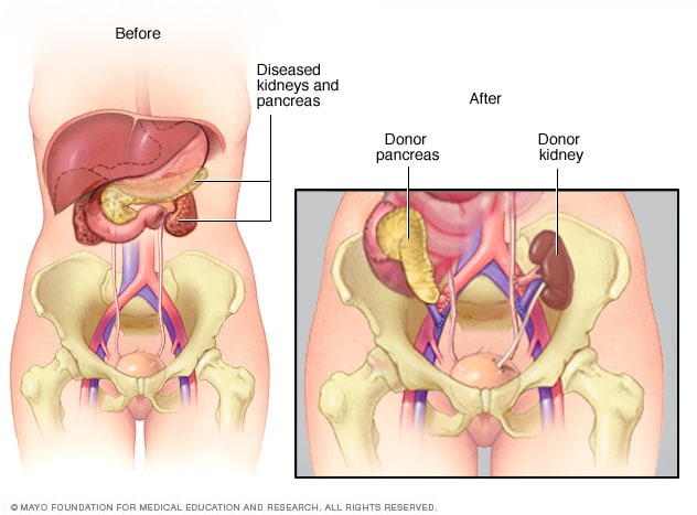 移植的胰腺和肾脏 