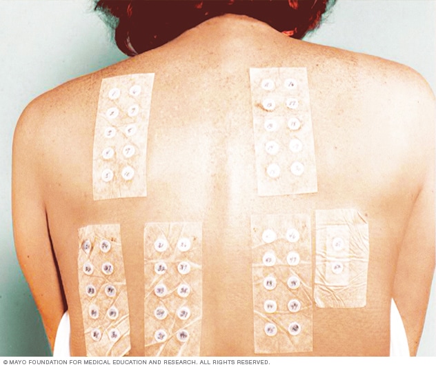 La prueba del parche en la espalda ayuda a identificar a qué eres alérgico.