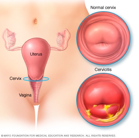 Ilustración de un cuello del útero normal y de un cuello del útero con cervicitis 
