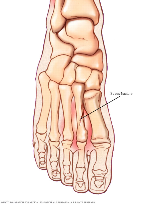 Stress fracture - Mayo Clinic