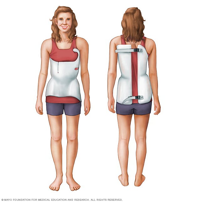 Scoliosis brace