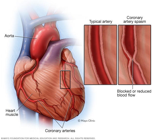 Espasmo de la arteria coronaria