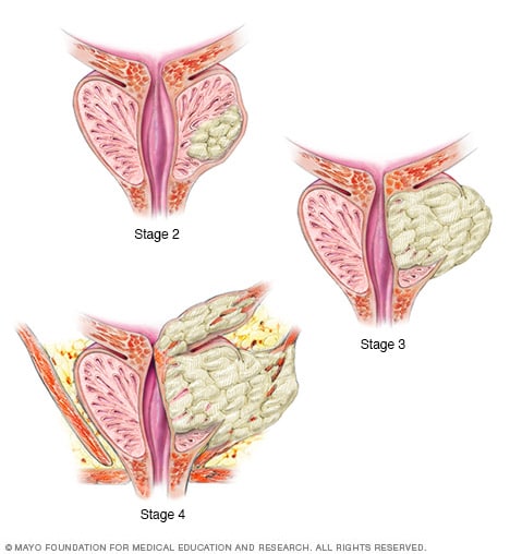 Illustration showing prostate cancer stages 