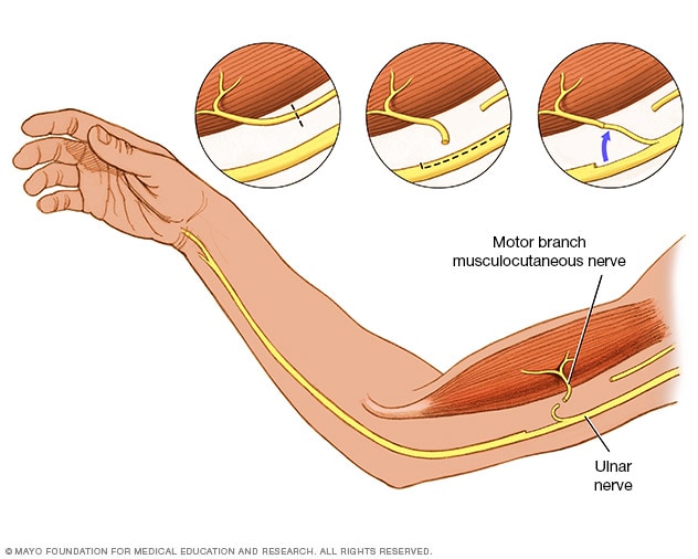 Nerve transfer - Mayo Clinic