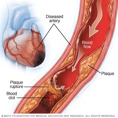 Ilustración de las causas de la isquemia miocárdica 