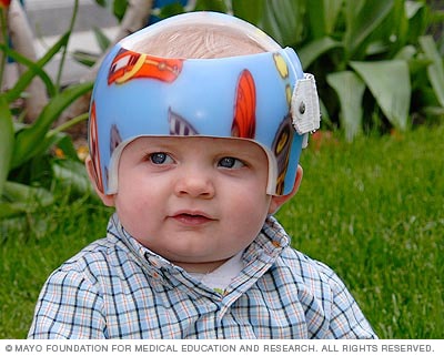 Baby wearing molded helmet