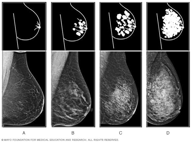 Films mammographiques montrant les quatre niveaux de densité mammaire