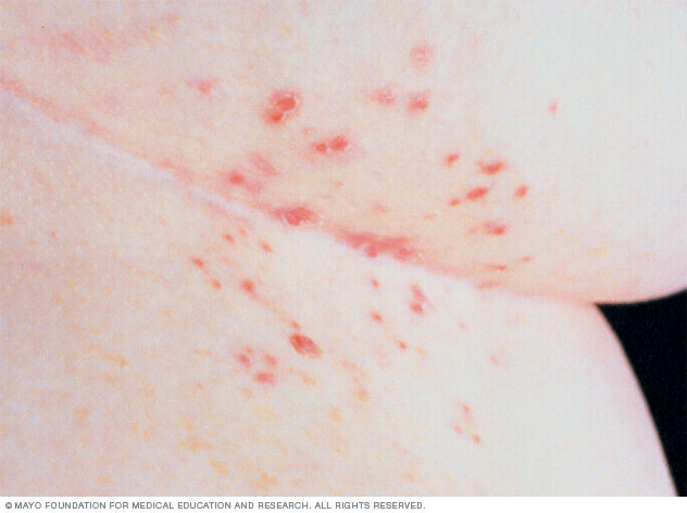 Scabies - Mayo Clinic